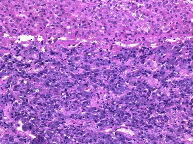 This histologic image depicts an adult human adrenal gland with cortical zona reticularis at the outer portion and medulla occupying the lower two-thirds of the gland. The medullary parenchyma is composed of chromaffin cells arranged in interconnected cords and nests, separated by a prominent fenestrated capillary network. Chromaffin cells display polygonal to round morphology with abundant eosinophilic cytoplasm and basophilic nuclei. Electron-dense, membrane-bound secretory vesicles containing catecholamines predominate within the cytoplasm, consistent with stored epinephrine as the major secretory product, with smaller stores of norepinephrine. The cortex shows layers surrounding the medulla, including the zona reticularis at the periphery, which has compact, darker-staining cords. The microvasculature supports rapid catecholamine release into the systemic circulation. Staining is consistent with routine light microscopy (H&E) typical for normal adrenal histology. Clinically, these features reflect the physiological role of the adrenal medulla in the sympathetic-adrenal axis, mediating the fight-or-flight response via epinephrine predominance. Diagnostic significance lies in recognizing normal medullary architecture and distinguishing it from neoplastic processes such as pheochromocytoma, which would alter cellular arrangement, cytology, and vascular patterns. This knowledge supports educational queries in histology, anatomy, and endocrine physiology, and aids radiology correlations when linking structural medullary features with hormonal secretory function and systemic adrenergic responses.