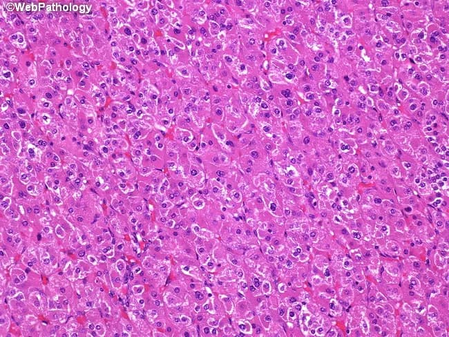 Imaging modality: Light microscopy of a Hematoxylin and Eosin (H&E) stained liver biopsy section examined under brightfield illumination. Primary site: liver parenchyma, hepatic lobule, hepatocytes arranged in cords separated by sinusoids. The cellular morphology shows polygonal hepatocytes with abundant eosinophilic granular cytoplasm and centrally placed round nuclei, occasional binucleation, and well-preserved cytoplasmic borders. Sinusoidal spaces appear patent with mild vascular congestion; there is no conspicuous steatosis, confluent necrosis, or prominent apoptosis in this field. Intercellular boundaries are intact; there is no significant inflammatory infiltrate or fibrotic septa evident in this limited view. Overall architecture is consistent with normal hepatic parenchyma, though a small sampling may miss portal tracts or fibrotic changes. No overt cytologic atypia or neoplastic features are obvious in this image. Diagnostic relevance: this image documents typical hepatocellular morphology suitable for educational reference and for distinguishing normal liver histology from inflammatory, degenerative, or neoplastic processes in hepatology and pathology practice. Potential clinical applications include baseline histology assessment in liver biopsies, evaluation of suspected fatty liver disease, viral hepatitis, or hepatocellular carcinoma if cytologic atypia present. Educational relevance extends to medical students, residents, and fellows; helps practice pattern recognition, differential diagnosis, and correlation with serology, imaging, and clinical course.
