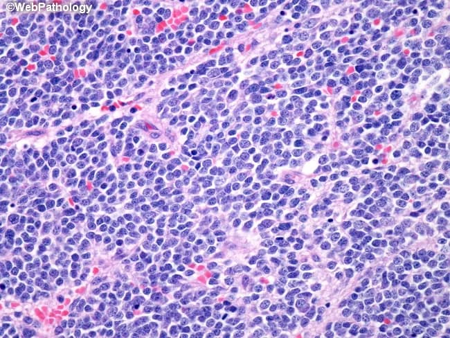 This histopathology image depicts bone marrow involvement by undifferentiated neuroblastoma. Obtained from a bone marrow biopsy and stained with hematoxylin and eosin, bright-field microscopy at high magnification (approximately 400x). The cellular pattern shows densely packed small round blue neuroblasts with high nuclear-to-cytoplasmic ratio, finely textured hyperchromatic nuclei, inconspicuous nucleoli, and scant cytoplasm. Cells are arranged in diffuse sheets with minimal intervening stroma; occasional Homer Wright–type rosettes may be present, reflecting neural differentiation. Mitotic activity is variable and cytologic features are consistent with embryonal neuroblastic morphology. The marrow is variably replaced by tumor cells, producing a high cellular density and occasional recrudescence of residual hematopoiesis at the periphery. Immunohistochemistry, when performed, typically demonstrates positivity for neuronal markers such as synaptophysin, chromogranin A, and neurofilament protein, supporting neuroblastic lineage; NB84 positivity may be observed in selected cases. Clinically, bone marrow involvement correlates with advanced disease and elevated catecholamines (serum VMA/HVA) in many patients. This image exemplifies a high-grade, poorly differentiated neuroblastoma phenotype, which carries prognostic and therapeutic implications, including risk-stratified chemotherapy, surgical planning, and monitoring for residual disease during follow-up. Recognition of perivascular tumor clusters and subtle stromal response can further refine staging and influence multidisciplinary management decisions in pediatric oncology practice.