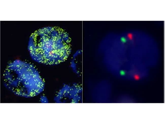 Fluorescence in situ hybridization (FISH) image showing MYCN gene status in neuroblastoma cells. The left panel depicts tumor cells with multiple green signals, indicating MYCN amplification and elevated copy number relative to normal. The right panel shows a control with normal diploid signals to demonstrate baseline copy number. This dual-color DNA FISH assay uses MYCN-specific probes (green) and a reference probe (red) for copy-number assessment. The specimen comprises neuroblastic tumor cells derived from a suspected adrenal or sympathetic chain lesion; histology is frequently undifferentiated or poorly differentiated with high mitotic activity and prominent nucleoli in MYCN-amplified tumors. MYCN amplification, defined as greater than 10 copies per diploid genome, is detectable by FISH, PCR, or immunohistochemistry and correlates with rapid tumor progression and poor prognosis; it often co-occurs with 1p deletion and 17q gain. Clinically, MYCN status is a critical prognostic biomarker that informs risk stratification, treatment intensity, and surveillance in neuroblastoma. The image demonstrates how copy-number gain translates into aggressive biology and aids in distinguishing high-risk from nonamplified tumors. This information supports diagnostic confirmation, prognostication, therapeutic decision-making, and research into targeted therapies. Correlative molecular testing across specimens enhances accuracy and guides enrollment in high-risk neuroblastoma trials and informs long-term management.