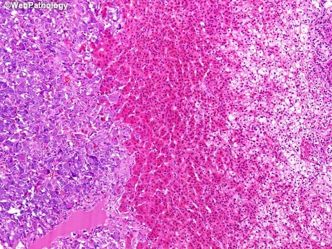 High-magnification light microscopy of an adrenal gland biopsy illustrating mixed cortical and medullary anatomy with a pheochromocytoma component. The left one-third of the image contains medullary tumor cells arranged in clusters and nests (zellballen) within a rich vascular stroma, characteristic of pheochromocytoma. These chromaffin cells exhibit polygonal to rounded outlines with granular, eosinophilic cytoplasm and round to oval nuclei. The central zone demonstrates cortical architecture: the middle band corresponds to zona reticularis, composed of cells with deeply eosinophilic cytoplasm arranged in an irregular network. The right one-third shows zona fasciculata, typified by large cords of cells with pale, vacuolated (lipid-rich) cytoplasm giving foamy appearance. This juxtaposition highlights the three adrenal compartments: medulla (pheochromocytoma) and two cortical zones (fasciculata and reticularis). Zona fasciculata and zona reticularis synthesize glucocorticoids (cortisol) and androgens/estrogens; their cytologic features reflect lipid content and steroidogenic activity. Clinically relevant: pheochromocytoma may secrete catecholamines; cortical zones participate in steroidogenesis. The image aids differential diagnosis among adrenal medullary tumors and cortical lesions, with potential correlations to hypertension, catecholamine excess, or hormonal syndromes. In educational settings, this slide exemplifies gross-to-histology correlations, cell morphology, pattern recognition (zellballen), and zonal adrenocortical histology, reinforcing terminology for endocrinology, pathology, and medical education.