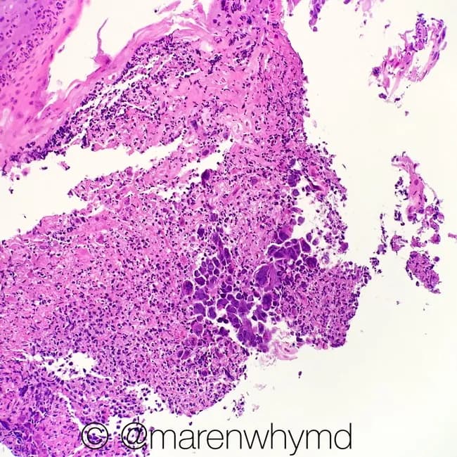Histopathology image of esophageal mucosa showing herpes simplex virus (HSV) esophagitis. Prepared as a formalin-fixed paraffin-embedded tissue section and stained with Hematoxylin and Eosin (H&E); light microscopy reveals an ulcerated mucosal surface with dense inflammatory infiltrate and focal islands of squamous epithelium. The hallmark cytopathic effect includes multinucleated squamous cells with margination of chromatin and prominent intranuclear ground-glass inclusions (Cowdry type A bodies) within enlarged cells at the ulcer margin. The surrounding stroma exhibits acute and chronic inflammatory cells, edema, and reactive basal cell hyperplasia. These findings distinguish HSV esophagitis from reflux esophagitis and other infectious esophagitides such as cytomegalovirus or candidal disease. The diagnostic significance rests on the classic viral cytopathic changes rather than clinical symptoms alone. Differential considerations include CMV esophagitis with owl’s eye inclusions (larger cells, intranuclear inclusions but different distribution), and candida esophagitis characterized by fungal hyphae and pseudomembrane formation. Clinically, HSV esophagitis supports antiviral therapy (acyclovir/valacyclovir) and prompts evaluation for immunocompromised status or underlying disease. This image is useful for medical education, pathology training, and research on herpesvirus–esophagitis pathology, illustrating the cytopathic effect and ulcer-associated histology in a gastrointestinal biopsy. Correlative immunohistochemistry may confirm HSV infection in ambiguous cases.