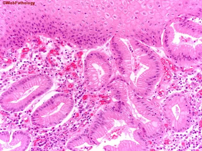Histopathology: Hematoxylin and eosin stained paraffin-embedded distal esophageal biopsy demonstrating Barrett-type mucosa with intestinal metaplasia. The squamous lining is replaced by specialized columnar epithelium containing scattered goblet cells, consistent with intestinal differentiation. Nuclei are basally oriented within mature enteric-type epithelial cells; goblet cells exhibit mucin-rich cytoplasm. There is no cytologic atypia or architectural disarray; nuclei show normal polarity; mucosal glands appear orderly with preserved stratification of superficial cells. Inflammation is mild; no Barrett dysplasia, no cellular atypia, no cribriforming, and no glandular crowding. The mucosa lies just proximal to the gastroesophageal junction; distribution is patchy to diffuse along the distal esophagus. Overall impression: Barrett esophagus with intestinal metaplasia, negative for dysplasia. Clinical significance: pivotal for surveillance strategy and cancer risk stratification; in BE, intestinal metaplasia defines eligibility for surveillance intervals; absence of dysplasia reduces immediate risk but requires longitudinal monitoring. Differential diagnoses include intestinal metaplasia without dysplasia vs. esophagitis with regenerative change or gastritis involving the distal esophagus. Correlation with endoscopy findings and prior biopsies is recommended to assess progression risk to low-grade/high-grade dysplasia or adenocarcinoma. This slide exemplifies BE pathology suitable for educational review, histology correlation, and pathology teaching slides.