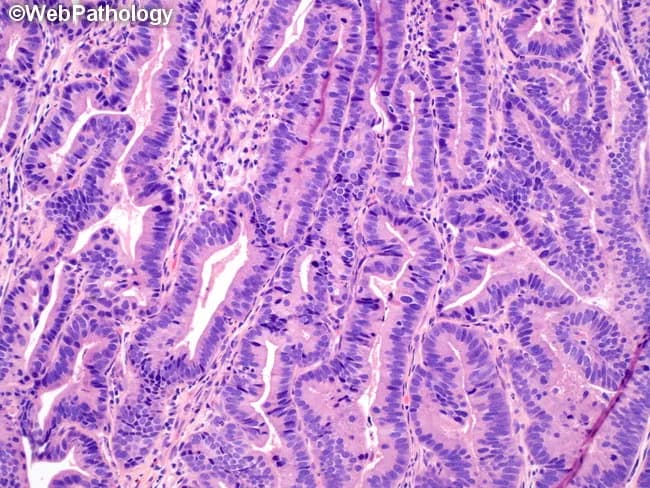 Histology image of Barrett esophagus with low-grade dysplasia illustrating intestinal metaplasia of the distal esophageal mucosa. The material is a formalin-fixed, paraffin-embedded biopsy section stained with hematoxylin and eosin and viewed at high magnification. The mucosa shows tubular glands with goblet cells characteristic of Barrett mucosa, embedded in lamina propria and terminating at the muscularis mucosae. In LGD, cytologic atypia is evident: mild to moderate nuclear pleomorphism, increased nuclear-to-cytoplasmic ratio, hyperchromasia, and pseudostratification of nuclei within dysplastic gland bases. Architectural crowding with elongated, irregular glands and occasional outpouchings is compatible with dysplastic change. Normal-appearing Barrett epithelium with intestinal metaplasia is present but lacks high-grade features or invasion. There is no invasion beyond the mucosa; no desmoplasia or submucosal invasion is seen. Clinically, Barrett esophagus with LGD carries a higher risk of progression to high-grade dysplasia or adenocarcinoma and supports intensified endoscopic surveillance or therapeutic eradication strategies. This image is relevant for educational comparison of LGD versus non-dysplastic BE and for radiologic-pathologic correlation, pathology slide review, and multidisciplinary case discussion in gastroenterology and pathology. No invasion beyond the muscularis mucosa is evident, underscoring mucosal-confined dysplasia. The image aids teaching on LGD criteria, biopsy interpretation, and risk stratification guiding endoscopic management today.