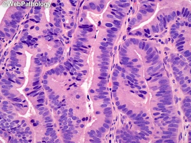 Imaging modality: Light microscopy of Hematoxylin and Eosin (H&E) stained tissue from a distal esophageal mucosal biopsy. The histology shows Barrett esophagus with intestinal metaplasia and areas of low-grade dysplasia. Within the mucosa, tall columnar epithelial cells with basally oriented nuclei form elongated, irregular glands that extend toward the luminal surface. Goblet cells containing mucin are present, confirming intestinal differentiation. Nuclear features include mild enlargement, hyperchromasia, and pseudostratification with slight crowding in the lower to middle thirds of the epithelium, while overall gland architecture remains relatively preserved in comparison to high-grade lesions. The lamina propria shows mild chronic inflammatory infiltrate; no invasion is evident. Overall, the lesion demonstrates early dysplastic changes consistent with LGD in Barrett mucosa: precancerous changes that portend progression risk if not managed. Diagnostic significance: LGD signals increased risk of progression to high-grade dysplasia and esophageal adenocarcinoma; requires close endoscopic surveillance and often endoscopic eradication therapy or risk-stratified management per guidelines. Potential clinical use: pathology teaching, gastroenterology training, endoscopic-luminal cancer risk assessment, research on BE progression. Keywords: Barrett esophagus, LGD, intestinal metaplasia, goblet cells, dysplasia, H&E, distal esophagus, GEJ, precancerous lesion, cancer risk, surveillance, endoscopic ablation. Importantly.