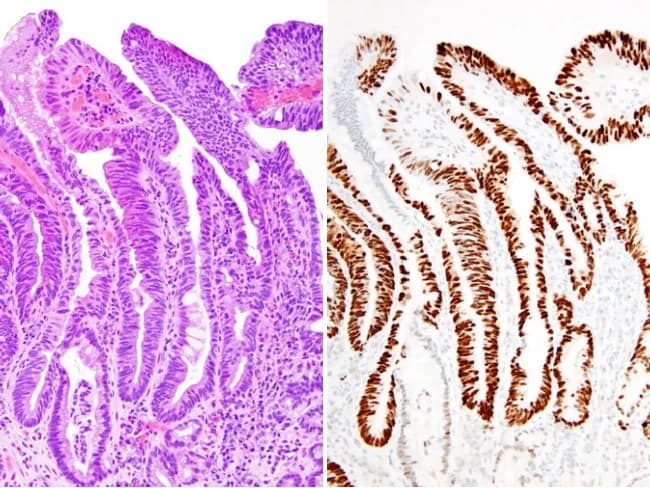 Two-panel histology image illustrating Barrett esophagus with high-grade dysplasia. Modality: Bright-field light microscopy of formalin-fixed esophageal biopsy tissue. Left panel shows hematoxylin and eosin (H&E) stained section revealing intestinal metaplasia in the distal esophagus with goblet cells, glandular architecture disrupted by architectural disarray, stratified, hyperchromatic epithelial nuclei, and mitotic activity consistent with high-grade dysplasia. Right panel demonstrates immunohistochemistry for p53, with strong nuclear brown staining accentuating dysplastic glands, reflecting p53 protein accumulation/mutational inactivation in the Barrett epithelium. The combination of BE with high-grade dysplasia and p53 overexpression supports TP53 pathway disruption and a higher risk of progression to esophageal adenocarcinoma. The image highlights the concordance between morphology and biomarker status, where p53 immunoreactivity correlates with molecular alterations (TP53 mutation) and may portend clonal evolution within BE. Clinically relevant for risk stratification, endoscopic surveillance strategies, and therapeutic decision-making, including consideration of early endoscopic eradication therapy. Visual features include intact surface mucosa with columnar epithelium, goblet cell-containing intestinal metaplasia, nuclear atypia, mitotic figures, and robust p53 positivity in dysplastic glands. This image is valuable for education, pathology training, and research into goblet cell metaplasia, BE progression, and targeted biomarker validation. These data support biomarker-guided management and targeted prevention of progression in BE.