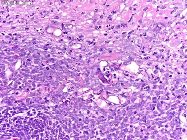 High-magnification light microscopy of a necrotic tissue biopsy stained with hematoxylin and eosin (H&E) reveals broad, nonseptate fungal hyphae with irregular, often wide-angle branching consistent with Mucorales (mucormycosis). The specimen shows extensive focal necrosis with loss of parenchymal architecture, irregular stromal disruption, and sparse neutrophilic and lymphohistiocytic inflammatory infiltrate. Within necrotic zones, thick-walled hyphae measuring approximately 5–20 μm in diameter traverse the tissue, displaying paucity of septa and occasional right-angle or variable-angle branching. The background demonstrates vascular congestion and occasional hyaline fungal elements; occasional sporangia are not clearly visible. The appearance is highly suggestive of invasive zygomycosis in an immunocompromised host or poorly controlled diabetes. Clinically important features include the need for rapid antifungal therapy (liposomal amphotericin B or amphotericin B), urgent surgical debridement, and correction of underlying acidosis or immunosuppression. Differential diagnosis includes Aspergillus species (septate hyphae with acute-angle branching), Fusarium, and other mould infections; however, septation and branching patterns help distinguish. The observation supports a diagnosis of fungal invasion in necrotic tissue, correlating with systemic signs of infection. In microbiology, culture and molecular assays can confirm genus. Utility: educational reference for histopathology, diagnostic pathology, and fungal infection management.