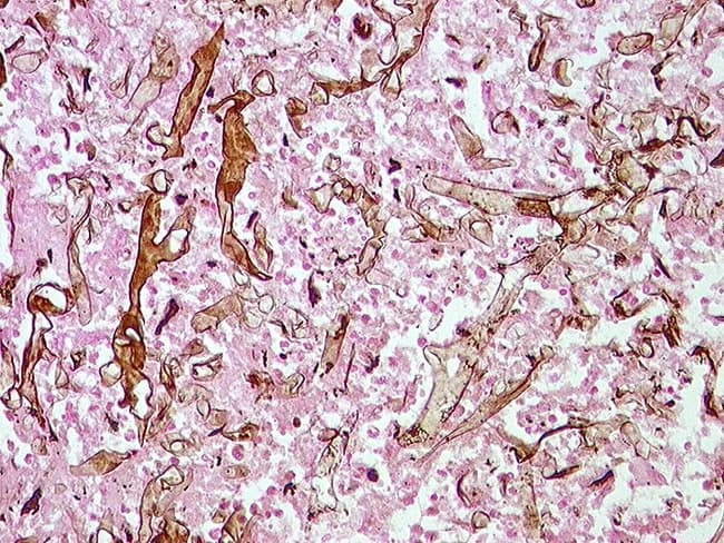 Imaging modality with technique details: Grocott methenamine silver stain applied to tissue biopsy. Light microscopy. The image shows a granulating necrotic focus with scattered, irregular thick fungal hyphae visible against a pale background. Hyphae are broad and variably wide, with intermittent septation and irregular, snake-like contours. The stain accentuates fungal cell walls in dark pigment (black/brown) on the eosinophilic necrotic tissue and inflammatory debris. The surrounding tissue demonstrates necrosis with sparse inflammatory cells. The morphological pattern is compatible with invasive molds; presence of hyphae within necrotic debris suggests tissue invasion. Distinguishing features include broad, nonseptate or pauci-septate hyphae with wide branching, a classic clue for Mucorales (mucormycosis); in contrast, Aspergillus would typically show narrow, septate hyphae with acute angle branching. Clinical correlation is essential given risk factors such as diabetes, neutropenia, or immunosuppression. The diagnostic significance lies in early recognition of invasive fungal infection to guide prompt antifungal therapy liposomal amphotericin B and surgical debridement where appropriate. Potential differential diagnoses include mucormycosis, aspergillosis, and other zygomycetes; PCR and culture should be performed for species-level identification. This image is a valuable educational resource for histopathology, infectious disease, and pathology training; courtesy of Dr. Katharina Glatz, University of Basel, Switzerland. Thank you.