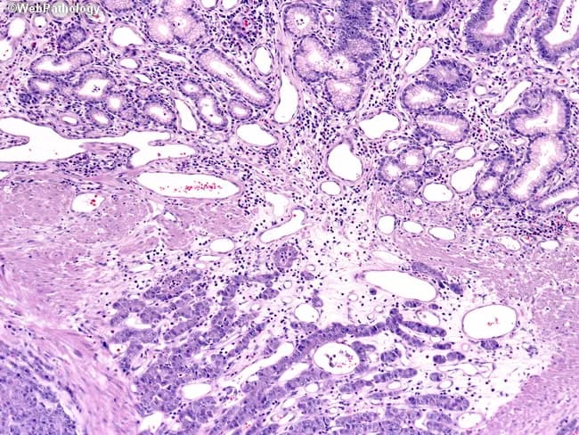 This histology image depicts a neuroendocrine carcinoma of the gastrointestinal tract, evaluated by light microscopy on a formalin-fixed paraffin-embedded tissue section stained with Hematoxylin and Eosin. The specimen is deep to the mucosa, in the submucosal compartment, consistent with an infiltrative neoplasm arising from the GI tract. At intermediate power, tumor cells are arranged in cohesive ribbons and trabeculae with cribriform-like infoldings and occasional nests within a fibrous stroma. The cells show increased nuclear-to-cytoplasmic ratio, hyperchromatic, grooved nuclei with irregular contours and conspicuous nucleoli; mitotic activity may be variable, with occasional apoptotic bodies; focal necrosis may be present in higher-grade lesions. The cytoplasm is scant to moderate, and a high-grade neuroendocrine carcinoma pattern is favored over a typical carcinoid. The architectural pattern, cohesive trabeculae, and back-to-back arrangement support a neuroendocrine phenotype; however, definitive classification requires immunohistochemistry (synaptophysin, chromogranin A, and Ki-67 proliferation index). Clinical correlation suggests a GI primary with regional/submucosal invasion; accurate grading (G1-G3) informs prognosis and chemo-sensitivity. Differential diagnoses include well-differentiated neuroendocrine tumor (carcinoid), small or large cell neuroendocrine carcinoma, and adenocarcinoma with neuroendocrine differentiation. This image is valuable for educational purposes, differential diagnosis discussions, and correlating histology with immunophenotype and clinical behavior.