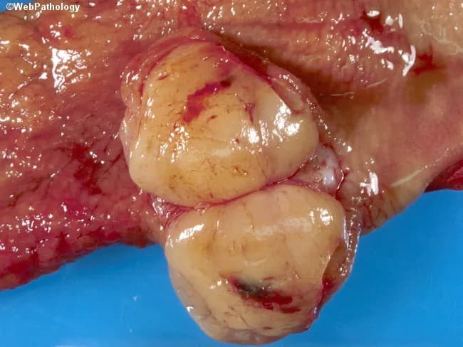 Gross pathology photograph of a resected gastric tumor illustrating the classic appearance of a gastrointestinal stromal tumor (GIST). The specimen demonstrates a solitary, well‑circumscribed, fleshy mass arising within the gastric wall, typically submucosal with a tan-yellow cut surface and occasional surface hemorrhage or focal necrosis. Gastric GISTs represent the most common mesenchymal neoplasms of the abdomen, with a predominance in the stomach (>50%), and most patients presenting in the sixth decade; pediatric cases are rare and may occur in the context of Carney triad. On gross examination, lesions are often exophytic or intraluminal and may appear as encapsulated nodules or plaque‑like thickenings. Definitive diagnosis requires microscopic evaluation and immunohistochemistry, including positivity for KIT (CD117) and DOG1, with variable spindle or epithelioid cell morphology and mitotic activity guiding risk stratification. The illustrated tumor’s solitary, well‑defined margins are consistent with a resectable, localized GIST, but differentiation from other submucosal spindle cell tumors (leiomyoma, leiomyosarcoma, schwannoma) relies on histology and immunophenotyping. Clinically, GISTs demand surgical excision and targeted therapy in select cases, and prognosis depends on size, mitotic rate, location, and rupture risk. This image is valuable for surgical pathology education, gross pathology training, and radiology–pathology correlation discussions.