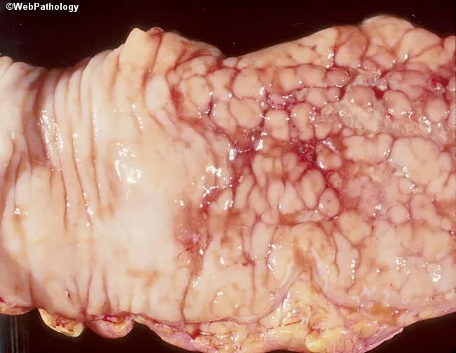 Macroscopic gross image of a resected bowel segment displaying marked mucosal disease. The right-hand mucosa shows a cobblestone pattern with discrete raised islands interspersed by shallow to deep ulcerations; a sharp demarcation separates involved from uninvolved mucosa on the left. These features arise from focal inflammatory changes producing mucosal edema, friability, and fissuring, yielding the characteristic cobblestone appearance. The mucosa appears erythematous with vascular congestion but without visible serosal perforation in this view. The pattern is suggestive of inflammatory bowel disease, most consistent with Crohn disease presenting as patchy skip-lesion involvement of the colon. The observed gross morphology supports clinical correlation and histopathologic confirmation to distinguish Crohn colitis from other causes of segmental ulceration, such as intestinal tuberculosis or ischemic colitis. Depth of ulceration cannot be determined from this surface image alone. This specimen provides essential gross-pathology context for surgical pathology, gastroenterology, and education, and would be indexed under inflammatory bowel disease, cobblestone mucosa, Crohn disease, skip lesions, mucosal ulceration, and colonic involvement. Keywords for search include colon, colonoscopy correlation, macroscopic bowel pathology, Crohn disease pattern, transmural inflammation suspicion, and gross mucosal pattern. Additional histology will optimize differential diagnosis and guide therapy in clinical practice.