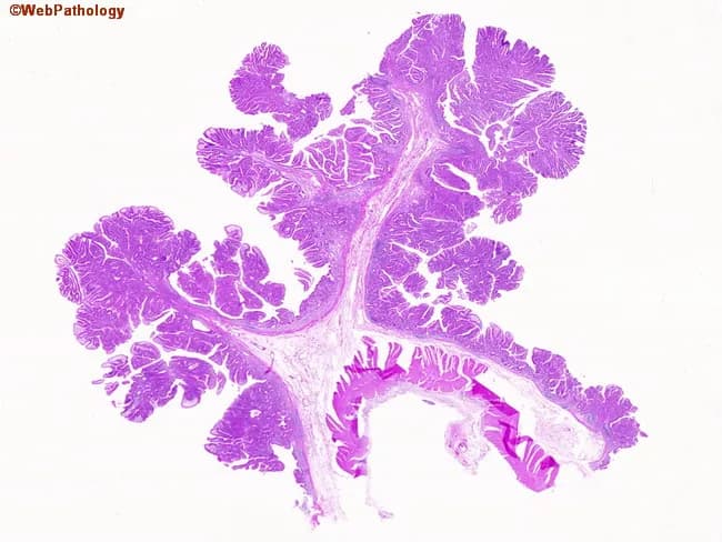 This image depicts a hematoxylin and eosin stained histology section observed under light microscopy. The tissue demonstrates prominent papillary architecture characterized by multiple arborizing papillary fronds with elongated, branching cores composed of fibrous stroma and precariously positioned capillary-like vessels. The papillary fronds are lined by a single or stratified layer of epithelial cells with basophilic nuclei, showing typical polarity and minimal cytologic atypia; mitotic activity is not evident at this magnification. The overall pattern is suggestive of a papillary neoplasm rather than a ductal or acinar structure, and the cores create a characteristic vascularized stalk that projects into a glandular lumen or cystic space. The image lacks clinical context but, in a diagnostic setting, would prompt consideration of papillary carcinomas depending on the organ of origin (e.g., papillary thyroid carcinoma, papillary urothelial carcinoma, papillary renal cell carcinoma). Differential diagnoses include benign papillary lesions and inflammatory papillary proliferations. Immunohistochemical panels (e.g., TTF-1, thyroglobulin for thyroid; GATA3, CK7/CK20 for urothelial; PAX8, RCC markers for renal) would be essential for tissue-of-origin determination. Clinically, recognizing papillary morphology in biopsy aids in tumor grading, staging, and guiding management decisions. This description emphasizes morphology and context to support searchability and educational utility.