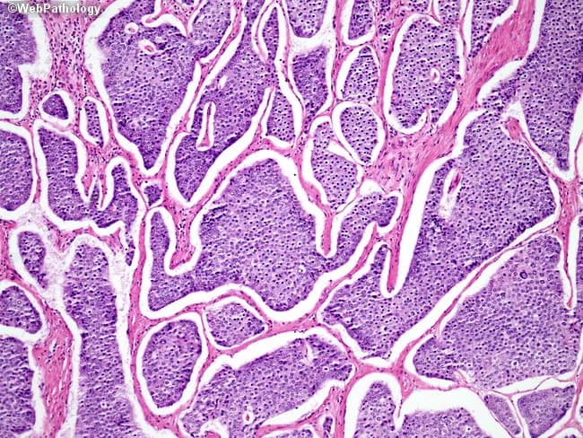 This is a light micrograph of thyroid gland tissue prepared for histopathology and stained with Hematoxylin and Eosin (H&E). The sample reveals multiple spherical to irregular follicles of varying size separated by wispy fibrous septa. The colloid-filled lumens are pink to pale pink, while the surrounding follicular epithelium is a uniform single layer of cuboidal to low-columnar cells with round to oval nuclei and inconspicuous nucleoli. No nuclear grooves, inclusions, or pseudoinclusions characteristic of papillary carcinoma are evident. The stromal background is relatively scant with no dense lymphocytic infiltrate or Hurthle cell metaplasia apparent. The architecture is reminiscent of normal thyroid parenchyma or benign nodular colloid goiter pattern, where follicle size varies and colloid predominates. There are no mitotic figures or cytologic atypia observed. This image demonstrates classic histology of endocrine gland tissue with preserved colloid and regular follicle lining, suitable as reference for normal thyroid architecture in educational, diagnostic, and research contexts. Clinically, such histology supports benign thyroid pathology when correlated with imaging and labs. In malignant differentials, absence of papillary nuclear features or tall columnar cells argues against papillary thyroid carcinoma; however, definitive diagnosis should consider capsule invasion and margin status in surgical specimens.