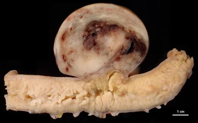 Gross pathology photograph of a resected small intestinal segment showing a subserosal/intramural, well-circumscribed, firm mass compatible with a gastrointestinal stromal tumor (GIST). The tumor appears tan-white with a nodular, rounded contour and a darker central area suggesting hemorrhagic or necrotic change; a scale bar indicates 1 cm and the lesion measures approximately 1.5–2 cm in diameter. GISTs originate from interstitial cells of Cajal within the bowel wall and often harbor activating mutations in CKIT (CD117) or PDGFRA. Clinically, GISTs present with abdominal pain, GI bleeding, or obstruction depending on size and location; prognosis correlates with tumor size, mitotic rate, and tumor location. On gross examination, these tumors are typically firm and well circumscribed within the GI tract and may show mucosal involvement or ulceration. Histology commonly reveals spindle or epithelioid cells in fascicles; immunohistochemistry shows CD117 and DOG1 positivity. Differential diagnosis includes leiomyoma, leiomyosarcoma, schwannoma, desmoid-type fibromatosis, and fibroma. Definitive diagnosis requires histopathology and mutational analysis; management centers on surgical resection and targeted therapy with tyrosine kinase inhibitors when appropriate. This image serves educational value for surgical pathology, gastrointestinal oncology, and radiology correlation, illustrating how gross features guide sampling, indicate intramural origin, and prompt targeted mutational testing for prognosis and therapy planning.