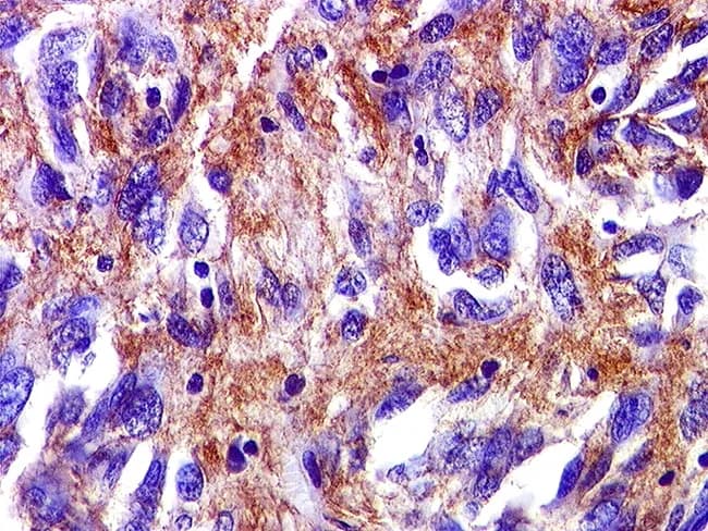 Immunohistochemical slide of a gastrointestinal stromal tumor (GIST) showing robust cytoplasmic/membranous brown staining on a hematoxylin counterstain background. The image likely represents a tissue section stained for CD117 (c-KIT) and/or DOG1, markers that confer high sensitivity and specificity for GIST. In this field, CD34 may be variably positive and SMA positivity can be focal, complicating differential diagnosis with leiomyosarcoma. The tissue is FFPE, sectioned at 4 μm, and stained with DAB chromogen to yield brown immunoreactivity. The tumor cells display spindle-cell morphology in fascicles embedded in a collagenous stroma; nuclei are ovoid to elongated with variable mitotic activity. The immunophenotype—predominant CD117 (c-KIT) and DOG1 positivity—supports the diagnosis of GIST, with DOG1 often providing superior specificity. The combined histology and IHC pattern differentiates GIST from smooth muscle and neural neoplasms. Clinically, this immunoprofile directs targeted therapy options (tyrosine kinase inhibitors such as imatinib or sunitinib) and informs mutational testing for KIT or PDGFRA to predict treatment response. This image is valuable for education in oncologic pathology, GI pathology, and diagnostic immunohistochemistry, illustrating how a mesenchymal GI tumor is identified by characteristic immunostains. It is suitable as a reference for immunophenotype, differential diagnosis, and molecular correlation in GIST research and teaching.