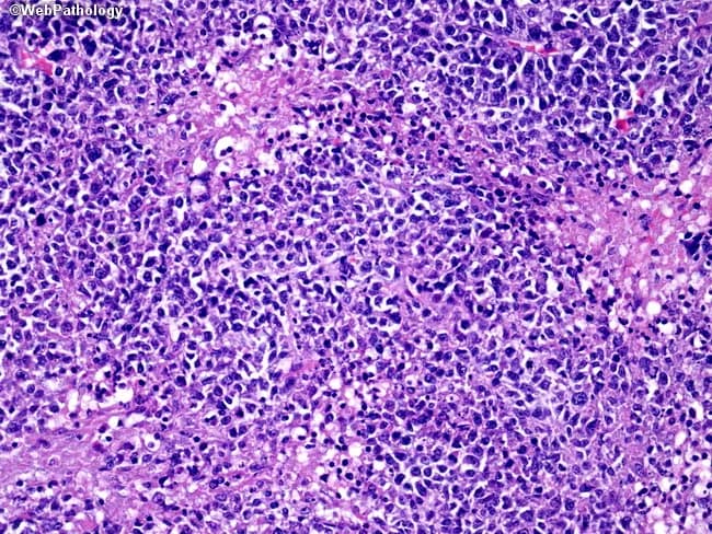 Imaging modality: Histopathology using light microscopy of a lymph node biopsy, stained with Hematoxylin and Eosin (H&E). The section shows diffuse effacement of nodal architecture by sheets of large malignant lymphoid cells, characteristic of diffuse large B-cell lymphoma (DLBCL). Cells are enlarged and discohesive, with marked pleomorphism: vesicular nuclei, prominent nucleoli, and irregular nuclear contours; cytoplasm ranges from scant to ample, contributing to variable cell size. A high mitotic rate is evident, with frequent apoptotic bodies and necrotic foci (necrosis prominent in this field). Background comprises scattered small non-neoplastic lymphocytes, macrophages, and dendritic cells, all overwhelmed by neoplastic population. The pattern lacks the orderly nodal architecture typical of reactive hyperplasia, consistent with a high-grade lymphoma. Immunophenotypic expectation includes CD20/CD79a positivity on lymphoma cells (not visible in H&E) and high proliferative index (Ki-67 often >60-80%), supporting aggressive behavior. These features explain rapid lymph node enlargement and potential systemic symptoms. Clinically, DLBCL (diffuse large B-cell lymphoma) is an aggressive non-Hodgkin lymphoma with variable nodal involvement; prognosis depends on stage, biology, and treatment response. This image is relevant for education on high-grade B-cell neoplasia, differential diagnosis with Burkitt lymphoma, and the importance of correlating histology with immunohistochemistry and staging for optimal management strategies.