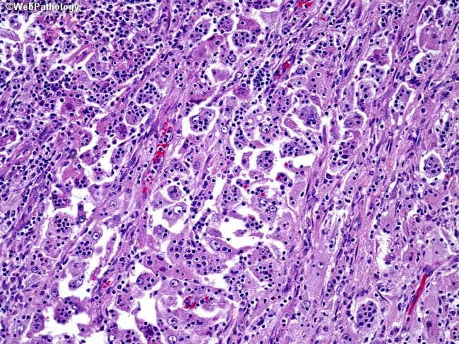 Imaging modality: Light microscopy of an H&E stained lymph node biopsy, captured at high magnification. Anatomical context: Lymphoid tissue within the lymphoreticular system, specifically lymph node parenchyma with sinusoidal expansion. The histology shows Rosai-Dorfman disease features: plump histiocytes with large, vesicular nuclei and prominent central nucleoli; cytoplasm is granular and eosinophilic. These histiocytes are embedded in a dense background of small lymphocytes and scattered plasma cells. A hallmark finding in this image is emperipolesis, where intact lymphocytes and other hematopoietic cells are variably situated within the cytoplasm of the histiocytes without destruction. Immunophenotypic context, although not shown here, typically reveals S-100 positivity in the histiocytes with CD68 positive and CD1a negative staining, supporting Rosai-Dorfman. The architectural pattern is that of sinus histiocytosis with histiocytes occupying sinuses and occasionally effacing normal nodal architecture. Clinically, Rosai-Dorfman presents with painless, often massive cervical lymphadenopathy and possible fever; the lesion is benign but can be progressive and extranodal involvement may occur. Diagnostic significance lies in recognizing emperipolesis and the characteristic histiocytic profile, which differentiates Rosai-Dorfman disease from Langerhans cell histiocytosis and infectious/inflammatory lymphadenitis. Potential educational and research use includes pathology training, differential diagnosis practice, and clinical-pathological correlation.