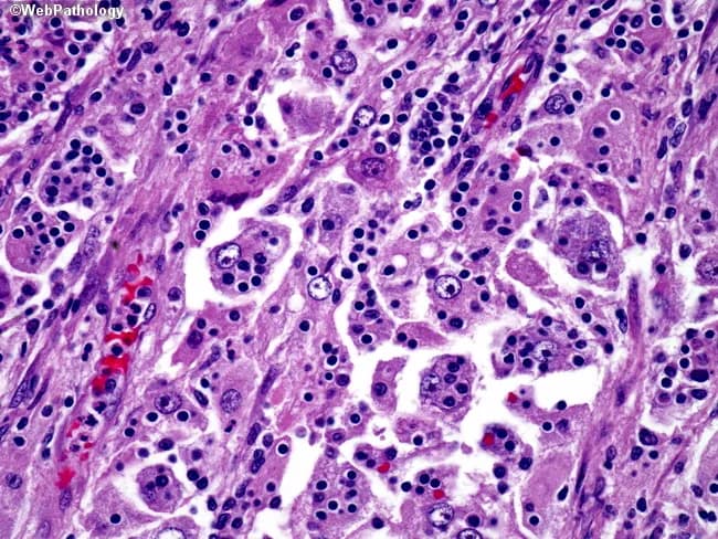 Imaging Modality: Light microscopy of a hematoxylin and eosin-stained lymph node biopsy section examined at high magnification. Primary subject: Rosai-Dorfman disease (sinus histiocytosis with massive lymphadenopathy), demonstrated by large pale histiocytes within nodal sinuses containing internalized, non-degrading lymphocytes. Morphology: prominent emperipolesis with intact lymphocytes traversing histiocyte cytoplasm; histiocytes show ample cytoplasm and irregular, vesicular nuclei amid a lymphoplasmacytic background. Immunophenotype (inferred from diagnosis, not visible in this image): S-100 positive and CD68 positive; CD1a negative, distinguishing from Langerhans cell histiocytosis. Architectural pattern: nodal sinus expansion with scattered histiocytes, occasional plasma cells, and preserved lymphoid architecture. Notable features: absence of necrosis or significant mitotic activity; absence of Birbeck granules on EM is not shown here. Diagnostic significance: emperipolesis within histiocytes is pathognomonic for Rosai-Dorfman when combined with supportive clinical context; differential diagnoses include LCH, reactive lymphadenitis, and other histiocytic disorders. Clinical correlation: commonly presents in children or young adults with generalized painless lymphadenopathy; extranodal involvement may occur. Potential clinical use: educational reference for histiocyte biology, emperipolesis, and differential diagnosis of histiocytic proliferations; guides immunohistochemical workup and clinical management planning. This image serves as a concise reference for learners to recognize emperipolesis and differentiate Rosai-Dorfman from other histiocytic disorders in education and diagnostic practice.
