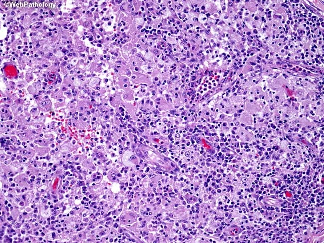 This histopathology slide depicts classic Rosai-Dorfman disease (sinus histiocytosis with massive lymphadenopathy) seen on light microscopy of a lymph node biopsy stained with Hematoxylin and Eosin. The tissue shows a dense, cellular infiltrate composed of large, pale histiocytes with vesicular or central nuclei and prominent nucleoli, intermingled with a background of lymphocytes and plasma cells. A key diagnostic feature is emperipolesis, wherein intact lymphocytes or plasma cells are observed within the cytoplasm of histiocytes, creating a striking, non-destructive intracytoplasmic engulfment. The architecture may be preserved or disrupted by proliferating histiocytes, and mitotic activity, if present, is typically low. Immunophenotype is not shown here but in standard practice Rosai-Dorfman histiocytes are S-100 positive and CD68 positive, helping distinguish from Langerhans cell histiocytosis and other histiocytoses. Clinically, the disease often presents with lymphadenopathy but may involve extranodal sites, including the gastrointestinal tract, where involvement is frequently incidental. Etiology remains uncertain; proposed triggers include infectious agents or immune dysregulation, yet no conclusive cause exists. Management varies from observation in self-resolving cases to chemotherapy in selected, progressive disease; many cases can follow a protracted course spanning years to decades. This image is well-suited for education on histiocytic disorders, differential diagnosis, and learning objectives related to emperipolesis.