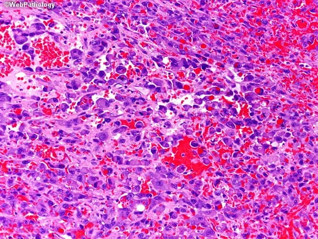 This histopathology slide displays a high-grade vascular neoplasm consistent with epithelioid angiosarcoma of the small intestine, in a patient with a history of radiation therapy for a prior malignancy. Under light microscopy using Hematoxylin and Eosin staining, atypical epithelioid endothelial cells form sheets and irregular, poorly defined vascular channels, with true lumina not readily evident. The tumor demonstrates marked nuclear pleomorphism, vesicular nuclei, conspicuous nucleoli, and abundant eosinophilic to amphophilic cytoplasm. Multinucleated giant cells are variably present. Hemorrhagic debris, erythrocyte extravasation, and numerous mitotic figures highlight high proliferative activity. Infiltrative growth into surrounding mucosa and muscularis propria can be inferred, with occasional spindle cell components and necrotic foci. The vascular differentiation is suggested by occasional intracytoplasmic lumina and red blood cell–containing spaces, though nonclassic channels predominate. Radiotherapy-related etiology is supported by clinical history; the lesion can arise years after exposure, particularly in the small intestine, and presents with GI bleeding, iron-deficiency anemia, or obstruction. Immunohistochemical confirmation is typically sought (CD31, ERG, factor VIII-related antigen) to differentiate from mimics such as Kaposi sarcoma, melanoma, or carcinoma. This image supports a high-grade, aggressive sarcoma with poor short-term prognosis and informs therapeutic planning including surgical excision and systemic therapy and follow-up.