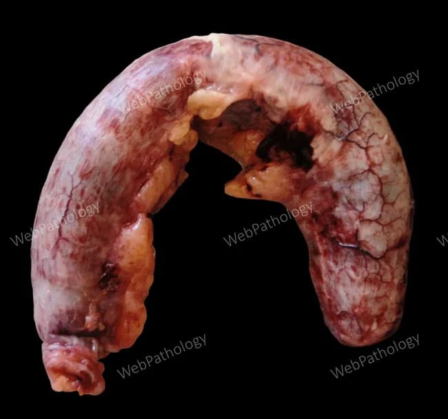Gross pathology photograph of a surgically excised vermiform appendix demonstrating acute inflammatory changes. The serosal surface is markedly hyperemic with pronounced vascular congestion. A fibrinopurulent exudate coats the external surface in several locations, imparting a pale, shaggy sheen against the inflamed, deep-red background. The organ is edematous and friable, with thickened wall and irregular contours at the tip; luminal patency is not evident from this exterior view. These macroscopic appearances correspond to the classic gross features of acute appendicitis: mucosal edema, mural inflammation, and serosal exudation that may herald further complication if not treated. The specimen displays variable color due to surface moisture, focal ecchymosis, and vascular markings consistent with inflammatory hyperemia. The image is helpful for gross-pathology education, surgical-pathology correlation, and radiology-pathology teaching, illustrating how inflammatory exudates appear on the serosal surface and how appendix morphology changes in acute inflammation. Potential clinical implications include the need for prompt appendectomy to prevent progression to perforation or periappendiceal abscess. This visual also supports differential considerations such as phlegmonous appendicitis and atypical presentations, reinforcing the role of gross assessment in guiding subsequent histopathologic evaluation and clinical management. The image is valuable for student bedside teaching and pathology gallery resources. Consistently used worldwide.