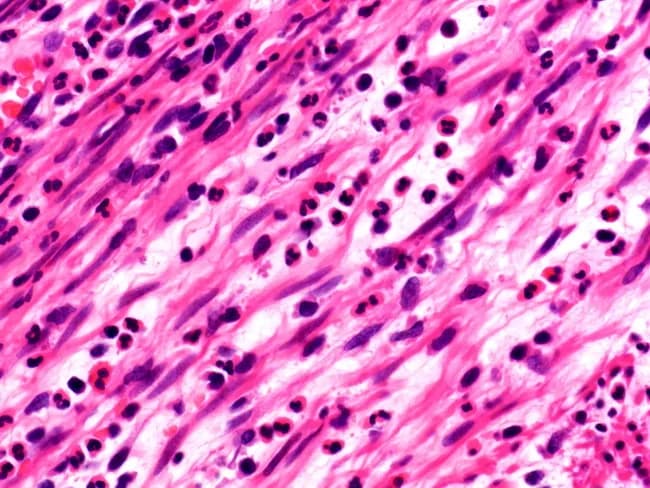 Imaging modality: light microscopy of hematoxylin and eosin stained appendix tissue, providing histopathologic confirmation of acute appendicitis. The specimen shows a cross-sectional or longitudinal histologic section of the appendix with transmural neutrophilic inflammation, most prominent in the muscularis propria, consistent with acute inflammatory process. Neutrophils are scattered in the mucosa and submucosa and form dense aggregates within the muscularis layer, with occasional microabscesses and disrupted tissue architecture. The lamina propria and mucosal glands are variably inflamed, and there is edema of the surrounding connective tissue with increased vascularity. The background stroma is pink and eosinophilic, with numerous dark-pigmented neutrophils and rare lymphocytes. The overall pattern supports acute appendicitis and correlates with clinical symptoms such as right lower quadrant pain, fever, leukocytosis. Pathologic significance: transmural neutrophilic infiltration denotes active infection of the appendix and raises concern for perforation if the process extends. Clinically, this image provides definitive diagnosis, guides surgical management, and informs postoperative antibiotic therapy. Differential considerations include early Crohn's disease involving the appendix, appendiceal diverticulitis, and secondary infectious or inflammatory processes. This image is relevant for medical education, pathology training, and research into inflammatory appendiceal disease. Clinical utility includes aiding diagnosis in equivocal cases and supporting teaching files for histology and surgical pathology.