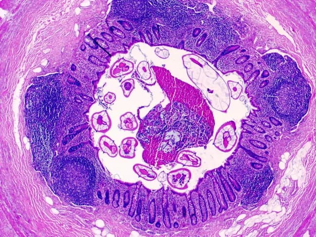 A high‑quality light microscopic image of a resected vermiform appendix demonstrates Enterobius vermicularis (pinworm) infection. The specimen was prepared as a paraffin section and stained with Hematoxylin and Eosin, viewed at high magnification (approximately 400x). The transverse cross‑sections reveal a circular arrangement of degenerative luminal parasites embedded in mucosa and luminal debris, with multiple adult pinworms characterized by a thick eosinophilic cuticle and distinctive lateral alae. The parasite bodies display a smooth, tapered morphology and a cylindrical outline; internal structures are limited by the staining. Surrounding appendiceal mucosa shows mild chronic inflammatory changes with eosinophilic infiltration, consistent with helminthic infestation rather than primary bacterial appendicitis. The focal luminal obstruction by parasites may account for symptoms or overflow. The image emphasizes gross features such as the worm's external cuticle and the lateral alae, as well as microanatomical context including mucosa‑submucosa interface and muscularis propria. Clinically, identifying pinworms in the appendix supports a diagnosis of enterobiosis and prompts anti‑helminthic therapy (e.g., albendazole or mebendazole) and screening of close contacts. This histopathology image is educational for parasitology, helminthic infections, surgical pathology, and differential diagnosis of appendiceal irritation in pediatric and adult patients.