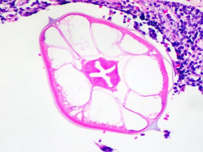 This brightfield light microscopy image shows a histologic cross-section of Enterobius vermicularis (pinworm) within a hysterectomy specimen. The nematode appears as a rounded, straw-colored structure with a thick, eosinophilic cuticle. The most distinctive feature is the lateral blade-like ridges along the worm circumference, diagnostic for pinworms. Internal anatomy includes a central digestive tract and surrounding musculature; the surrounding colonic mucosa/submucosa demonstrates mild inflammatory infiltrate with eosinophils, lymphocytes, and occasional plasma cells. The orientation is transverse, revealing the layered circular muscle and cuticular ridges within cross-section. Clinically, this incidental finding has limited impact on gynecologic cancer management but confirms Enterobius vermicularis infestation in the gastrointestinal tract. Differential considerations include other nematodes such as Ascaris lumbricoides and Trichuris trichiura, which have distinct cuticular patterns. The diagnostic significance lies in recognizing a common intestinal parasite in an extraneous surgical specimen; this image serves educational and parasitology morphology purposes for pathologists, residents, and medical students, highlighting characteristic transverse cross-sections and spined cuticle morphology.