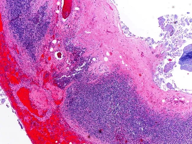 Low-magnification light microscopy of an appendix reveals a wall thickened by dense acute and chronic inflammatory infiltrate involving mucosa, submucosa, and portions of the muscularis. The lumen is variably compressed by edema and hemorrhage. Within the inflamed appendiceal wall, several Entamoeba histolytica trophozoites are evident in the center of the field; these trophozoites display pale cytoplasm and a small, dark nucleus, frequently containing ingested red blood cells, and are best appreciated on subsequent higher‑power images. The surrounding tissue shows neutrophilic and mononuclear inflammation, crypt destruction, and focal ulceration, consistent with amoebic appendicitis. Adjacent serosa may exhibit reactive edema. This histopathologic pattern supports a diagnosis of amoebic (Entamoeba histolytica) infection rather than typical bacterial appendicitis, with diagnostic significance for targeted anti-parasitic therapy (e.g., metronidazole) followed by luminal agents. Clinically, the finding correlates with acute abdomen symptoms, travel/ endemic exposure, and stool studies or serology. In differential considerations include bacterial gangrenous appendicitis, ischemic changes, and other intestinal parasites; normal variants are not present in this specimen. This image is a teaching example for surgical pathology, infectious disease correlation, and gastrointestinal parasitology education. Keywords: amoebic appendicitis, Entamoeba histolytica, parasitic appendicitis, histology, H&E, appendix, trophozoites. Educational resource for clinicians.