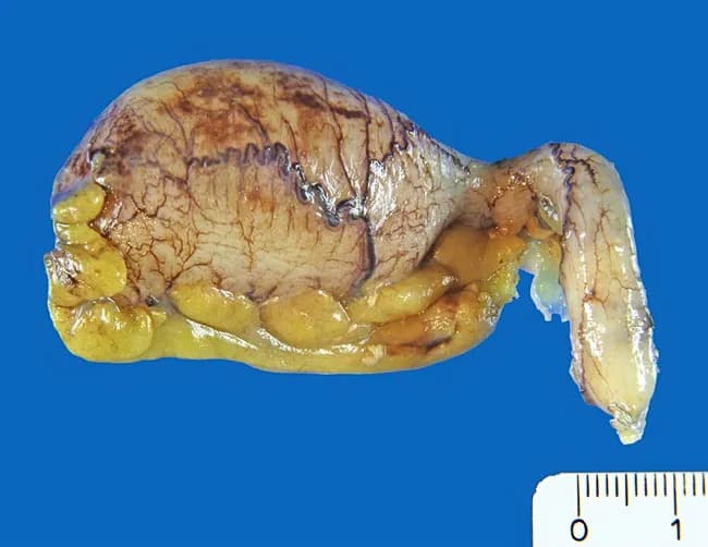 Gross pathology photograph of a surgically excised vermiform appendix. The specimen demonstrates bulbous dilation of the distal (tip) portion with a lobulated, pale-tan surface and fine vascular markings; a portion shows cystic, mucin-filled spaces projecting from the tip. Scale markings (centimeter ruler) are visible for size reference. The interior of the dilated segment contains mucinous material, and the cystic lining is lined by mucin-producing epithelium with cytologic atypia, without obvious stromal invasion on this gross view. The overall pattern is compatible with a benign mucinous cystadenoma (low-grade appendiceal mucinous neoplasm); however, the presence of atypia warrants careful histologic assessment to exclude mucinous cystadenocarcinoma. Radiographic or gross features may include appendiceal mucocele-like dilation. Notably, the lesion has a risk of rupture with potential peritoneal seeding if not completely excised. This image highlights key gross features: bulbous tip expansion, mucin-filled lacunae, delicate mural vasculature, and mucinous epithelium lining. Clinically relevant use cases include educational reference for gastrointestinal pathology, differential diagnosis between benign mucinous cystadenoma and malignant mucinous neoplasms, and correlation with histopathology to guide surgical management and prognosis. This representation is valuable for medical students, residents, and pathologists studying appendiceal mucinous neoplasms and pseudomyxoma peritonei risk assessment in various clinical education settings.