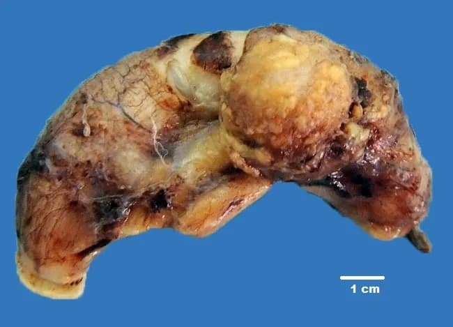 Gross pathology of an appendectomy specimen reveals an enlarged, dilated appendix with multiple cystic loci containing viscous mucinous material. The specimen measures approximately 8 cm in length with a maximum external diameter near 5 cm; the mucin-filled chambers create a lobulated, sponge-like appearance along the distal portion of the organ. The cut surfaces show translucent to pale-yellow cystic spaces, rimmed by a thin fibrous wall. Histology (described in the accompanying histology image) demonstrates simple mucinous columnar epithelium lining the cystic lumina with goblet cells and abundant mucin, consistent with a mucinous cystadenoma of the appendix. There is no obvious invasion into the serosa reported in this case, supporting a benign mucinous appendiceal neoplasm. Clinically, elderly patients may present with right lower quadrant pain and an ultrasound showing an enlarged appendix; mucinous appendiceal neoplasms can present as appendiceal mucocele and may carry risk of rupture with peritoneal seeding, such as pseudomyxoma peritonei if spilled during surgery. The diagnostic significance lies in distinguishing benign mucinous cystadenoma from mucinous cystadenocarcinoma; surgical resection is curative for localized lesions. Differential diagnoses include mucinous cystadenocarcinoma, mucinous hyperplasia, and nonneoplastic mucocele. This image and description provide essential context for gross-pathology-radiology correlation, surgical planning, and educational prompts on appendiceal mucinous neoplasms.