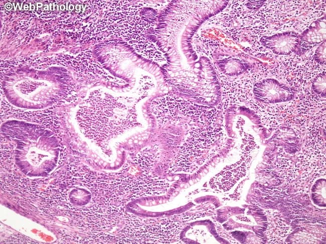Histology: Light microscopy of a colon biopsy stained with Hematoxylin and Eosin (H&E). The mucosal architecture is distorted with irregular, branched crypts and crypt atrophy, hallmarks of chronic colitis. Prominent neutrophilic infiltration within crypt lumens forms crypt abscesses, a striking feature of active inflammation. The lamina propria is dense with chronic inflammatory cells including lymphocytes and plasma cells, with goblet cell depletion and mucin paucity. Epithelial injury is present with surface irregularities and occasional erosions. Basal plasmacytosis may be seen. The mucosa demonstrates edema and increased vascularity. Granulomas are not evident in this field, and there is no transmural involvement visible in a single mucosal biopsy. Overall, the pattern favors ulcerative colitis over Crohn disease when correlated clinically. The findings reflect both active (crypt abscesses, luminal neutrophils) and chronic (crypt distortion, architectural irregularity) disease components. Diagnostic significance includes confirmation of inflammatory bowel disease with colitic histology, assessment of activity, and guidance for therapy selection. Differential considerations include Crohn’s colitis, infectious colitis, ischemic colitis, and pseudomembranous colitis. Clinical correlation with symptoms and endoscopic appearance is essential for accurate diagnosis and management planning. Correlation with clinical history ensures accurate diagnosis and therapy.