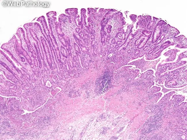 Histopathology image of colonic mucosa from a patient with long-standing ulcerative colitis undergoing surveillance. Prepared tissue is stained with hematoxylin and eosin and examined under light microscopy. The site demonstrates chronic inflammatory changes with mucosal architectural distortion and crypt architectural irregularities characteristic of inflammatory bowel disease, alongside a discrete neoplastic-appearing focus. The lesion exhibits tubular gland formation with elongated, hyperchromatic epithelial nuclei, nuclear stratification, and relative preservation of goblet cells in a dysplastic mucosa, consistent with a tubular adenoma-like focus in the setting of colitis. Adjacent mucosa shows a prominent crypt abscess at the right edge, with neutrophilic infiltrates within crypt lumens and significant inflammatory cell infiltration in the lamina propria. The background mucosa displays ongoing chronic inflammation, regenerative hyperplasia, and fusion of crypts. Clinically this finding is significant because IBD-associated dysplasia can evolve to colorectal carcinoma; distinguishing neoplastic from regenerative changes is essential, requiring careful correlation with endoscopic features and, when feasible, targeted biopsies. The four-quadrant random sampling and targeted biopsies during colonoscopic surveillance aim to detect dysplasia early. In UC with coexistent primary sclerosing cholangitis, cancer risk is higher and surveillance intervals are tightened. End result: dysplastic-appearing area within inflamed mucosa raises concern for DALM or IBD-associated neoplasia.