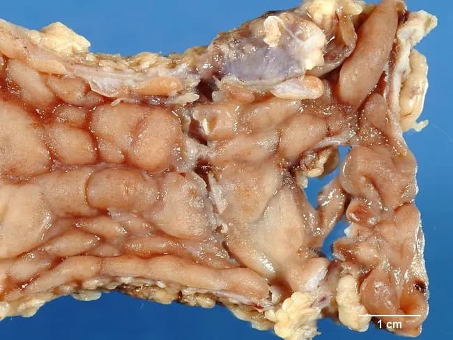 Gross pathology photograph of a Crohn disease-affected colonic segment illustrating classic transmural inflammation with segmental involvement. The specimen reveals discontinuous disease with skip areas and sharp demarcation between inflamed and untouched mucosa. Deep longitudinal ulcers are present, some oriented horizontally in the image, connected by shorter transverse ulcers, producing a serpentine configuration. The mucosa is edematous and may show hemorrhage or exudate; islands of bulging uninvolved mucosa create a cobblestone appearance. With time, chronic inflammation drives fibrosis and muscularis propria hypertrophy, resulting in wall thickening and luminal narrowing known as stricture. Serosal surfaces may show creeping fat, a fat wrapping phenomenon where mesenteric fat encroaches on the serosa. Transmural involvement predisposes to fissures, fistula formation, and, in advanced disease, regional scarring. The specimen likely represents Crohn colitis rather than ulcerative colitis, given the patchy distribution and transmural changes. The gross pattern correlates with potential surgical complications, including obstruction, fistulization, and abscess formation. This image is valuable for education on helical, segmental bowel pathology, highlighting the cobblestone mucosal pattern, serpiginous ulcers, skip lesions, and the characteristic transmural, full-thickness inflammatory process. Correlation with clinical history and radiologic findings reinforces diagnostic confidence and informs therapeutic planning, including medical therapy versus surgical resection strategy.