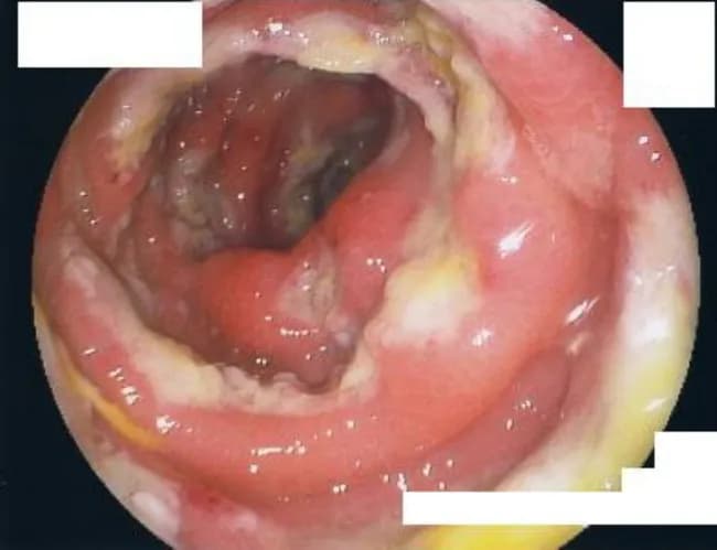 Endoscopic colonoscopic image of the right colon (cecum and ascending colon) from an immunocompromised patient with amebic dysentery. Modality: colonoscopy with white-light endoscopy; gold standard diagnosis remains colonic biopsy. Macroscopic mucosal changes are characterized by multiple punctate ulcers measuring 2–10 mm, with adherent yellowish exudate and surrounding erythema. In advanced areas, ulcers may coalesce to create large necrotic cavitations with relative sparing of normal intervening mucosa. The mucosa appears inflamed, edematous, friable, and susceptible to superficial bleeding on instrumentation. This distribution and morphology—predominantly in the right colon—are classic for amebic colitis, though overlap with other infectious or inflammatory conditions occurs. Endoscopic assessment guides biopsy targeting and therapeutic planning; histopathology or molecular testing corroborates Entamoeba histolytica infection. Diagnostic significance is high in immunocompromised individuals because amebic disease can progress to fulminant colitis and require surgical resection. Differential diagnoses include bacterial colitis (Salmonella, Shigella, Campylobacter), cytomegalovirus colitis, invasive fungal infections, and Crohn’s disease. Clinically, patients may present with abdominal pain, fever, diarrhea with blood, and weight loss. This image serves educational purposes, illustrating characteristic colonic ulcers with exudate and necrosis, supporting differential diagnosis and biopsy site selection, and highlighting the severe endoscopic phenotype that can precipitate colectomy.