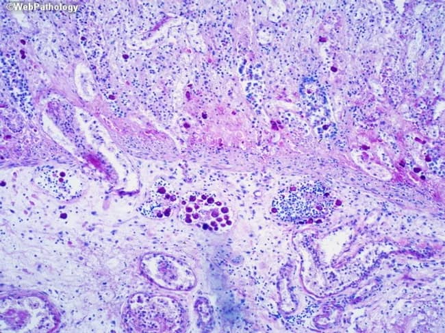 This image is a brightfield light microscopy slide of colonic mucosa stained with Periodic Acid–Schiff (PAS), highlighting Entamoeba histolytica trophozoites within inflamed tissue. The specimen type is gastrointestinal mucosa biopsy. The primary subject includes magenta PAS-positive amoebic trophozoites, visible as irregular, vacuolated cytoplasm containing ingested material, often adjacent to neutrophilic and mononuclear inflammatory cells. The tissue architecture shows disrupted mucosal glands, ulceration, and lamina propria infiltration, typical of amoebic colitis. The magenta organisms stand out against a pale pink to purple backdrop; chromotrope-rich cytoplasm and endosome-like vacuoles are evident; occasional red blood cells may be within trophozoite cytoplasm if present. This staining pattern (PAS) enhances detection of the cytoplasmic glycogen-rich trophozoites, aiding differentiation from host cells and other pathogens. Clinically, histopathology confirmation supports a diagnosis of Entamoeba histolytica infection and guides anti-amoebic therapy. The image demonstrates classic features of tissue-invasive amebiasis in the colon, with potential for flask-shaped ulcers, necrosis, and focal microabscess formation. This content is relevant for gastroenterology, pathology education, infectious disease diagnosis, and histology training, illustrating the diagnostic significance of PAS-positive trophozoites. Potential differential diagnoses include nonpathogenic Entamoeba dispar and PAS-positive fungal organisms; but cooperation of clinical data is essential.
