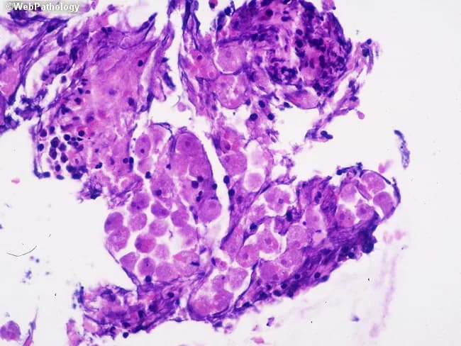 This is a bright-field light microscopy image of a colonic mucosal biopsy stained with Hematoxylin and Eosin (H&E), at high magnification (approximately 400x total). The histology shows inflamed colonic mucosa with an inflammatory exudate in the lamina propria and within the ulcerated mucosal surface. Within this exudate, round to oval trophozoites with granular cytoplasm and a small, centrally placed karyosome are evident, consistent with Entamoeba histolytica. These trophozoites may contain ingested erythrocytes, a characteristic diagnostic clue for invasive amebiasis. Alveolated borders (pseudopodia) are not readily visible in all fields but may be inferred by amoeboid cytoplasm. The surrounding tissue demonstrates acute and chronic inflammatory infiltrates, with neutrophils, macrophages, and occasional eosinophils; focal mucosal necrosis and ulceration are possible. The image highlights tissue invasion by protozoa within a colitis framework, supporting a diagnosis of amebic colitis rather than noninvasive Entamoeba species. Clinically, this histopathologic pattern correlates with dysentery, abdominal pain, and potential systemic spread if untreated. Diagnostic significance lies in identifying Entamoeba histolytica trophozoites in tissue, guiding antiparasitic therapy (metronidazole or tinidazole) followed by luminal eradication therapy. This image is relevant for educational pathology teaching, differential diagnosis of colitis, and research on invasive enteric protozoa. This educational image aids clinical correlation.