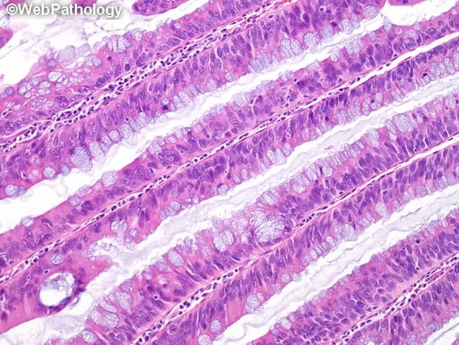 This histology image depicts colonic mucosa displaying villous adenomatous architecture with low-grade dysplasia. Prepared as a routine hematoxylin and eosin stained section, the villous processes are lined by columnar epithelium exhibiting architectural crowding, branching, and cryptal pseudostratification. There is hypercellularity with nuclear overcrowding; nuclei are moderately enlarged and elongated, hyperchromatic yet maintaining orderly polarity. Nucleoli are not prominent. Goblet cell mucin shows partial loss, contributing to a basophilic cytoplasmic appearance on H&E. Mitotic activity is not significantly increased, arguing against high-grade features. The mucosal glands demonstrate lack of maturation from crypt base to luminal surface, with vertical growth and irregular gland size; mucin depletion and basophilia accentuate the neoplastic epithelium. Overall, the lesion is an adenomatous polyp with villous architecture and low-grade dysplasia, a premalignant neoplasm in the colorectal tract. On imaging and clinical context this corresponds to a colon polyp with villous pattern, requiring complete endoscopic resection and histologic subtyping to determine malignant potential. Diagnostic significance includes risk stratification for progression to high-grade dysplasia or invasion; differential diagnoses include tubular adenoma with villous features, mixed adenoma, serrated lesions; clinical correlation: colonoscopy findings, patient age, and polyp burden inform management. Planning for surveillance is essential.