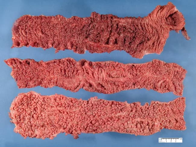 Imaging modality: Gross pathology photograph of a colectomy specimen with extensive mucosal polyposis. Primary subject: Familial Adenomatous Polyposis (FAP) characterized by hundreds to thousands of colonic polyps. Specimen type: colectomy (colon) showing a broad, polyp-dense mucosal surface. Imaging perspective: exterior view of longitudinally oriented colon segments, highlighting the mucosal polyp burden. Detailed description: The colon shows a remarkable burden of tiny polypoid lesions distributed across the mucosa. Most polyps are diminutive, under 1 cm in greatest diameter, giving a rough, nodular surface with a cobblestone appearance. The tissue coloration is a uniform reddish-pink. The polyps arise from the colonic mucosa with variable pedunculation; adenomatous-type appearance is suggested by their regular rounded contours and granular surface. This gross phenotype aligns with classic FAP, often associated with APC gene mutations, particularly around codons 1250-1464 (notably near codon 1300), producing profuse polyp formation. Mutations toward the extreme 5' and 3' ends yield attenuated polyposis. In this case, the description notes that approximately 25% of patients harbor colorectal cancer at colectomy. Clinically, such specimens illustrate the rationale for prophylactic colectomy to mitigate near-certain cancer risk. Credit: image courtesy of Dr. Jean-Christophe Fournet; humpath.com; Used with permission.