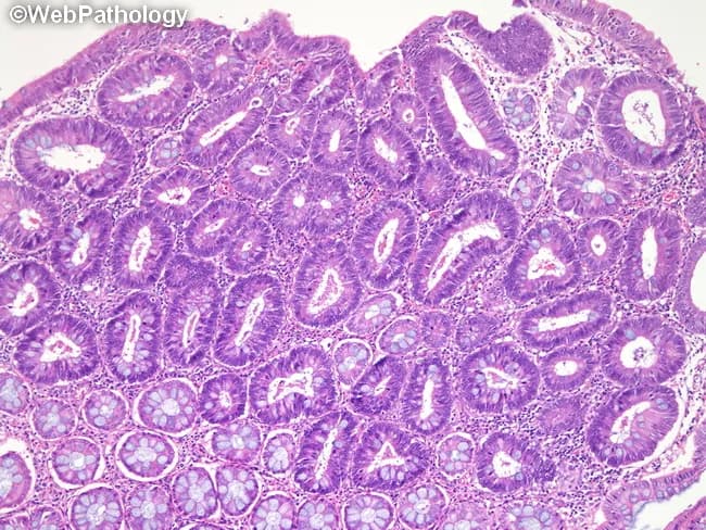 High-magnification histology image of a colonic adenomatous polyp in familial adenomatous polyposis (FAP). Modality/technique: light microscopy of a formalin-fixed, paraffin-embedded tissue section stained with Hematoxylin and Eosin (H&E). Specimen: colorectal mucosa, polypoid lesion arising from the tubular epithelium. Anatomical site: large intestine (colon), colonic mucosa with tubular adenomatous glands, showing back-to-back architecture and crowded, elongated glands with pseudostratified, hyperchromatic nuclei. Goblet cells are variably decreased; mucin depletion may be present. The epithelial cell layer exhibits dysplastic features including nuclear atypia, increased mitotic activity in the basal thirds, and loss of mucosal polarity. Overall polyp displays a tubular histology pattern with uniform, round luminal profiles and regular basement membrane. The stromal compartment is relatively dense with fibromuscular cores commonly seen in polyps; no definite invasion beyond the lamina propria is evident at this magnification. In the context of FAP, such adenomas demonstrate a high propensity for rapid development and progression toward colorectal carcinoma if not managed with surveillance and prophylactic colectomy. Clinically, this finding supports genetic testing for APC mutation and intensified colonoscopic surveillance; differential diagnoses include tubulovillous adenoma, villous adenoma, serrated lesions, or mucosal hyperplasia. Correlation with family history and prior polyp burden is critical for risk stratification and surgical planning.