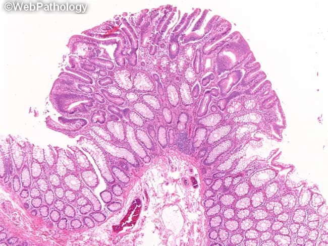 Imaging modality: Bright-field light microscopy of a hematoxylin and eosin (H&E) stained colonic polyp section. The tissue is a polyp from the colon in a patient with familial adenomatous polyposis (FAP). The histology shows colonic mucosa with a proliferation of elongated, crowding tubular glands forming a small, sessile polypoid lesion. Glandular architecture is predominantly tubular, with dysplastic epithelium demonstrating nuclear enlargement, hyperchromasia, and pseudostratification; goblet cells are variably reduced. The lamina propria shows mild stromal edema without invasion, and the crypt epithelium displays mitotic activity limited to the lower two thirds. The overall appearance is consistent with a tubular adenoma arising in the setting of FAP. The image highlights precancerous pathology, important for risk stratification and surveillance planning. Clinically, tubular adenomas in FAP carry a substantial lifetime risk of colorectal cancer and require intensified endoscopic monitoring and genetic counseling. The high-magnification view emphasizes microarchitectural features such as tightly packed, elongated glands and dysplastic cytology that differentiate adenomas from hyperplastic polyps. This micrograph is relevant for educational purposes, pathology teaching, and research into adenoma biology, APC-related tumorigenesis, and polyp progression to colorectal cancer. Correlative clinical management may include APC gene testing, familial counseling, and consideration of colectomy options; this histology aids grading dysplasia and guiding surveillance.
