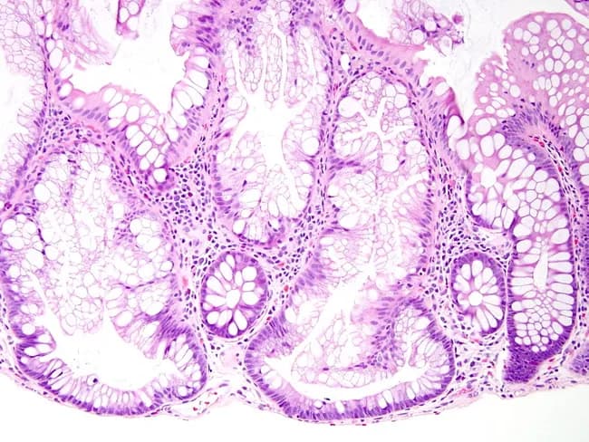 Histopathology image of Hematoxylin and Eosin (H&E) stained colorectal mucosa illustrating a sessile serrated adenoma (SSA) in the right colon. The tissue section shows non-pedunculated, broad-based crypts with characteristic serrated (sawtooth) architecture, especially apparent at the crypt bases where dilatation and lateral spreading occur. The crypts exhibit elongated profiles with intraluminal folds and crowding of basal goblet cells and absorptive columnar cells, each with a basally located nucleus and abundant mucinous cytoplasm. The proliferative zone extends into the middle to upper thirds of the crypts, distinguishing SSA from hyperplastic polyps in which proliferative activity is confined to the lower third. Mucosa demonstrates focal architectural distortion but lacks overt invasion in this field. The lesion is premalignant, linked to the serrated pathway of colorectal carcinogenesis, and contributes to roughly 15% of colorectal cancers; right-sided predominance and association with older female patients are characteristic clinical patterns. Clinically, this histology supports endoscopic identification and complete excision, with implications for surveillance intervals and cancer risk assessment. Differential considerations include hyperplastic polyp and traditional serrated adenoma; correlation with endoscopic appearance and molecular testing (e.g., BRAF mutation, CpG island methylator phenotype) may refine risk stratification. Pathology.