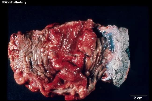 Gross pathology image of a resected sigmoid colon segment showing a bulky colorectal carcinoma. The tumor mass is exophytic, lobulated, and red-purple in color, with irregular, friable surfaces and clear demarcation from adjacent normal mucosa. The anal mucosa is visible to the right of the lesion, illustrating the tumor’s distal extent toward the rectosigmoid junction. A 2 cm scale bar is provided for size reference. The lesion distorts the colonic wall with thickening and luminal narrowing, consistent with invasive growth through the mucosa and into the submucosa and muscularis propria in a gross examination. Gross variants described in literature include exophytic polypoid masses, flat/depressed ulcerating infiltrative lesions, napkin-ring constrictions in distal colon, mucinous gelatinous appearances, and signet-ring cell related linitis plastica in advanced disease; these features are not all simultaneously present here, but the image exemplifies exophytic-type colorectal carcinoma. This macroscopic morphology correlates with potential lymphovascular invasion and nodal metastasis risk, and it supports clinical staging and surgical decision-making. The specimen’s appearance provides valuable educational context for understanding colorectal cancer pathology, morphology, gross differential diagnoses (polypoid adenocarcinoma, ulcerative cicatrix), and correlation with imaging and endoscopic findings. This image supports educational reference for residents, pathologists, and gastroenterology trainees in clinic and research settings.