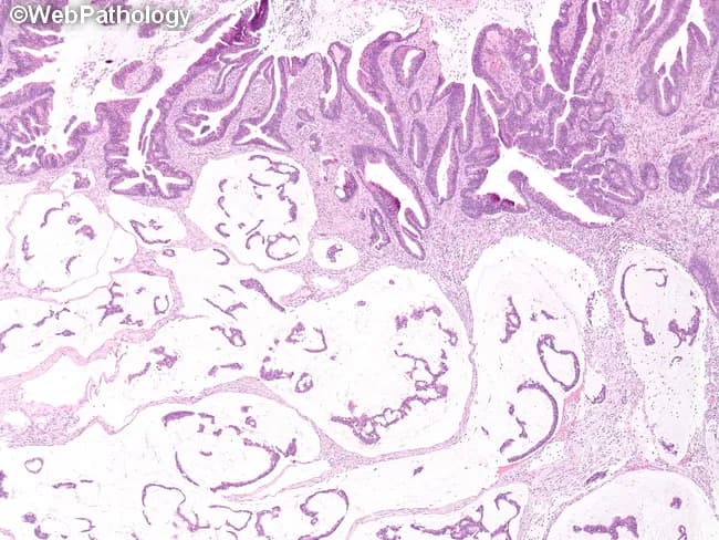 Imaging modality and technique: light microscopy of a formalin-fixed colorectal tissue section stained with Hematoxylin and Eosin (H&E). In this mucinous variant of colorectal adenocarcinoma, the tumor demonstrates abundant extracellular mucin pools separating irregular, branching or anastomosing neoplastic glands. The glands are lined by tall, columnar epithelium with goblet-cell–like mucin cytoplasm; cytologic atypia is generally minimal and mitotic activity is relatively low compared with high-grade conventional adenocarcinoma. The neoplastic cells project into mucin lakes, producing a characteristic sign of mucinous histology. The surrounding stroma may be looser or inflammatory, and residual non-neoplastic mucosa is variably present at the periphery. The histologic pattern may be accompanied by mucin-positive secretions within glands and throughout the extracellular matrix. This morphological subtype frequently correlates with distinctive molecular features, including mucin expression patterns such as MUC2 predominance, and possibly MUC1/MUC3 in other variants; serrated variants may show MUC2/MUC5AC/MUC6 upregulation. Clinically, mucinous colorectal carcinomas tend to present at a different stage distribution and may have different prognostic implications compared with conventional colorectal adenocarcinoma. Immunohistochemical profiling for mucin core proteins can aid classification and guide targeted therapeutic considerations, with potential implications for surgical planning and adjuvant therapy choices.