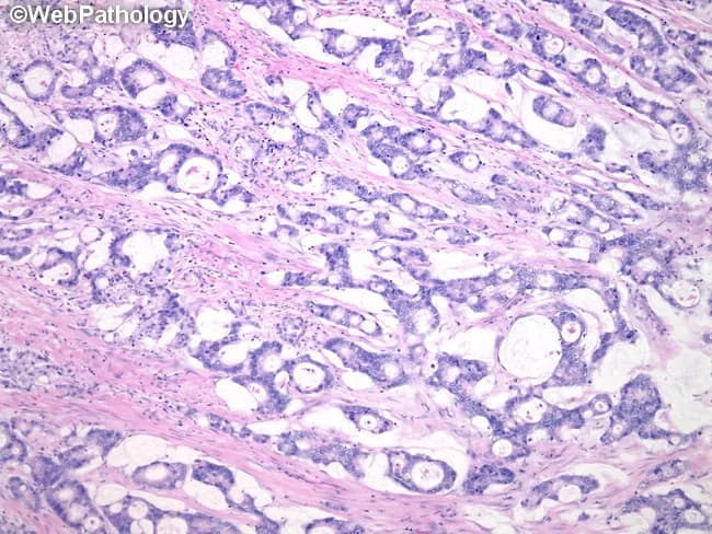 Imaging modality: Light microscopy of a hematoxylin and eosin (H&E) stained colorectal tissue section. Primary subject: Mucinous variant of colorectal adenocarcinoma with moderately differentiated neoplastic glands surrounded by abundant extracellular mucin in a desmoplastic stroma. The histology shows clusters of malignant glandular units lined by columnar epithelial cells with moderate cytologic atypia, nuclear pleomorphism, and irregular contours. These glands are interspersed with large lakes of mucin, which displace and pull apart the surrounding fibrous stroma. The desmoplastic reaction appears as dense, fibrous connective tissue with activated myofibroblasts and sparse inflammatory cells. Glandular architecture is irregular and commonly displays cribriform or back-to-back patterns, with variable mitotic activity. The tumor demonstrates notable mucin production both within gland lumina and as extracellular mucin pools; this mucinous pattern typically lacks cohesive invasion in some areas but can invade through the muscularis propria. Diagnostic significance: histologic confirmation of a mucin-producing colorectal carcinoma, with implications for prognosis and therapeutic planning; mucin-rich tumors can have distinct molecular features (e.g., mismatch repair deficiency) and may influence response to chemotherapy. The image is relevant for diagnostic pathology review, tumor classification, educational illustrate mucinous differentiation, and oncologic decision-making. Correlation with clinical presentation and imaging aids comprehensive assessment and management planning.