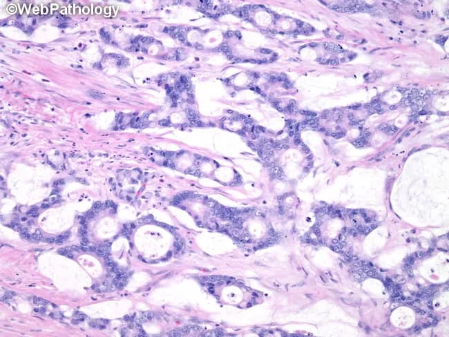 Histopathology slide of colorectal tissue examined under light microscopy after Hematoxylin and Eosin staining. The specimen architecture shows a mucinous variant of colorectal adenocarcinoma characterized by moderately differentiated neoplastic glands embedded in abundant extracellular mucin pools within a conspicuous desmoplastic stroma. Neoplastic glands display epithelial atypia with nuclear pleomorphism, hyperchromasia, and increased mitotic activity, arranged in back-to-back glands with cribriform or clustered patterns interspersed within mucin lakes. The tumor produces copious mucin which displaces adjacent stroma and forms lakes that are partially lined by neoplastic epithelium. The surrounding stroma is fibrous and dense (desmoplastic), with inflammatory infiltrates and occasional hyalinization. No evident invasion of vessels or nerves is clearly visible at this low magnification, but the desmoplastic reaction supports invasive carcinoma. The mucinous phenotype has clinical implications: often associated with higher stage at presentation, potential for peritoneal dissemination, and variable response to chemoradiation. This image is indicative of colorectal cancer of mucinous subtype and underscores the importance of recognizing mucin-rich histology as a distinct clinicopathologic entity with prognostic and therapeutic relevance. Correlation with immunohistochemical profiles (CK20, CK7, MUC2, MUC5AC, CEA) can aid differential diagnosis, confirm lineage, and guide targeted therapy decisions in multidisciplinary tumor boards for optimal patient management today.