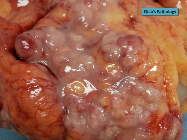 Gross pathology photograph of a resected sigmoid colon specimen showing a serosal surface densely studded with grayish-white, firm to soft nodules. The nodules are subserosal in location, compressing underlying adipose tissue and focal serosal irregularity is evident. The appearance is characteristic of serosal implants seen with advanced colorectal neuroendocrine carcinoma. The primary tumor is in the sigmoid colon; the nodules on the outer serosal surface suggest peritoneal dissemination or subserosal metastatic spread. The color is pale gray to pink-turquoise with a glistening, lobulated contour in places. The surrounding colonic wall shows irregular thickening and mucosal involvement consistent with an aggressive neuroendocrine tumor; vascular congestion is mild. In the clinical setting, such gross features raise concern for metastatic disease and peritoneal carcinomatosis; histopathology would reveal sheets of neuroendocrine cells with immunohistochemical positivity for chromogranin A and synaptophysin, high mitotic activity, and a high Ki-67 index. This image is valuable for education on gross morphology of colorectal neuroendocrine carcinomas and their serosal metastases, contributing to differential diagnosis with carcinoid tumors, adenocarcinoma metastases, and granulomatous processes. It supports imaging-pathology correlation, surgical pathology review, and teaching scenarios in gastrointestinal oncology. These features underscore the importance of correlation with clinical staging.