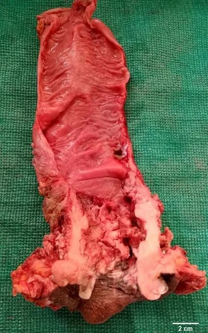 Macroscopic photograph of an anal canal/perianal surgical specimen illustrating an ulcerating, fungating squamous cell carcinoma. The lesion is distal to the dentate line, with a friable, red-tan mass protruding from the anal verge and invading surrounding perianal skin. The gross appearance is polypoid to verrucous in architecture, with irregular, necrotic surfaces and visible areas of tissue destruction at the margin. Early stages may be small, mobile, and exophytic; with progression, the tumor can extend proximally into the rectum, where it may resemble primary rectal adenocarcinoma on a gross exam. In distal growth, the tumor breaches the anal skin, producing ulceration and secondary inflammatory change that can mimic benign inflammatory processes. The current specimen demonstrates advanced disease with a conspicuous, ulcerated surface and anastomotic or transmural extension toward nearby tissues. Basaloid variants, if present, characteristically arise proximal to the dentate line and may be difficult to detect clinically on external examination. Case history provided by pathology and surgical teams contextualizes the image within a typical clinical presentation of anorectal malignancy. Correlation with histology and immunohistochemistry remains essential for definitive classification and therapeutic planning. This image supports education on gross pathology, differential diagnosis, and surgical oncology considerations. Educational utility for clinical trainees.