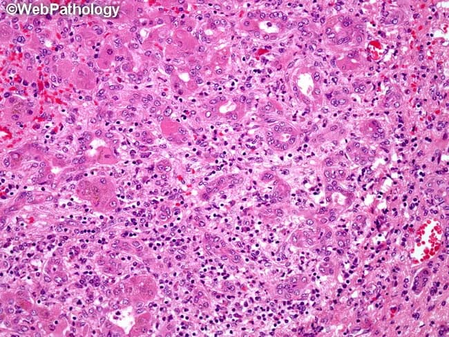 Light microscopic liver histology from a biopsy in acute hepatitis B shows portal areas (portal triads) with dense mononuclear inflammatory infiltrates, predominantly T lymphocytes, often with plasma cells. Inflammation extends from the portal tract into adjacent parenchyma, producing interface activity and mild lobular disarray. Hepatocytes exhibit cytoplasmic ballooning degeneration and scattered apoptotic bodies (Councilman bodies) in degenerating hepatocytes. Focal hepatocellular necrosis may be present, with preserved overall lobular architecture in early disease. Bile ducts within portal tracts are typically preserved; there is no marked cholestasis or fibrotic scarring at this stage. The pattern is compatible with acute viral hepatitis, most commonly hepatitis B, though similar features can appear in other viral or drug-induced liver injuries. Correlation with serology (HBsAg positivity, anti-HBc IgM, HBV DNA) supports the diagnosis. Clinically, the histology explains transaminase elevation and jaundice associated with acute hepatic injury. Diagnostic significance lies in recognizing portal-centric inflammation, interface hepatitis, and hepatocellular injury as a viral hepatitis pattern; differential diagnoses include acute hepatitis A and C, HDV co-infection, drug-induced liver injury, or autoimmune hepatitis. This image is valuable for medical education, pathology teaching, and radiology–pathology correlation discussions. These features emphasize portal inflammation and hepatocyte injury as diagnostic hallmarks for education purposes.