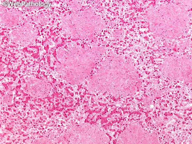 Histopathology of liver tissue from an HIV-positive patient with Mycobacterium avium complex infection. Modality: light microscopy of FFPE liver biopsy; Hematoxylin and Eosin stained section with subsequent Ziehl-Neelsen acid-fast stain. Anatomical location: hepatic parenchyma within the hepatic lobules, sinusoids and portal tracts. Macroscopic pattern: discrete, non-necrotic nodular aggregates of sinusoidal histiocytes (Kupffer cell-derived macrophages) scattered throughout the parenchyma; nodules vary in size. Microscopy shows abundant foamy or epithelioid histiocytes filled with acid-fast bacilli on Ziehl-Neelsen staining; multinucleated giant cells are rare. The granulomatous response is non-necrotizing, with preserved tissue architecture and occasional central macrophages forming small clusters. Inflammatory cells are limited, without caseation. Acid-fast organisms appear as slender red rods within macrophages; bacterial load can be high in disseminated infection. Diagnostic significance: hepatic MAC infection in immunocompromised hosts supports disseminated mycobacterial disease; finding AFB within histiocytes confirms infection and guides antimicrobial therapy. Pathophysiology: intracellular replication of MAC within Kupffer cells leading to granulomatous hepatitis; differential includes M. tuberculosis, other non-tuberculous mycobacteria, fungal granulomas. Clinical correlation: in AIDS, this pattern correlates with low CD4 counts and high mycobacterial burden; management requires combination antimycobacterial therapy and immune reconstitution strategies, with culture and molecular identification. This image exemplifies disseminated hepatic infection patterns clearly.
